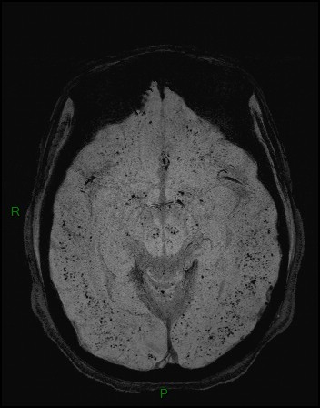 Cerebral fat embolism (Radiopaedia 35022-36525 Axial SWI 10).jpg