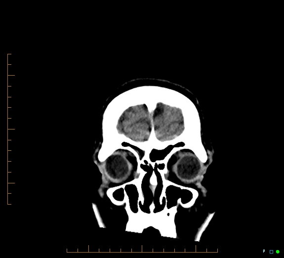 Cerebral fat embolism (Radiopaedia 85521-101220 Coronal non-contrast 9).jpg