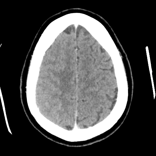 Cerebral hemorrhage secondary to arteriovenous malformation (Radiopaedia 33497-34561 B 43).png