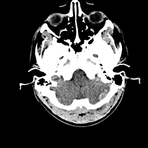 File:Cerebral hemorrhagic contusions- temporal evolution (Radiopaedia 40224-42753 Axial non-contrast 5).png