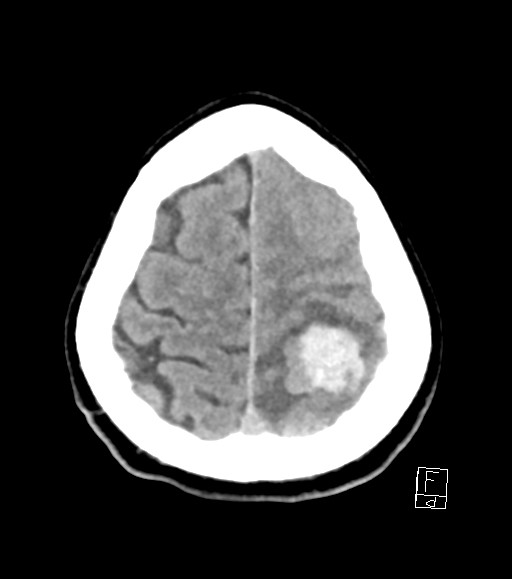 Cerebral metastases - testicular choriocarcinoma (Radiopaedia 84486-99855 Axial non-contrast 12).jpg