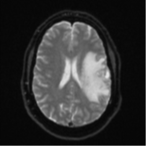 File:Cerebral metastases mimicking multifocal glioblastoma (Radiopaedia 50843-56353 Axial DWI 17).png