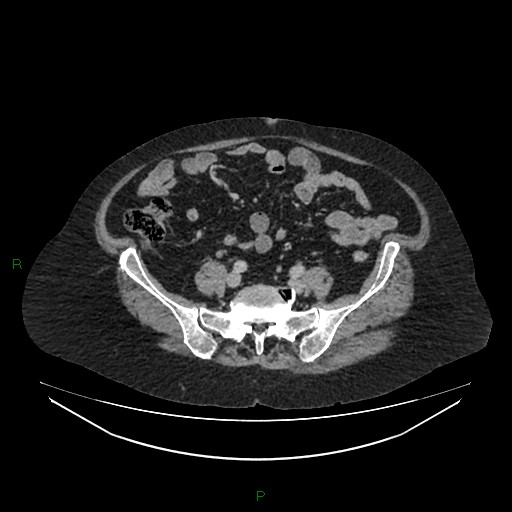 Cerebral metastasis from renal cell carcinoma (Radiopaedia 82306-96378 A 130).jpg