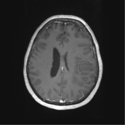 File:Cerebral metastasis mimicking glioblastoma (Radiopaedia 69155-78937 Axial T1 C+ 44).png
