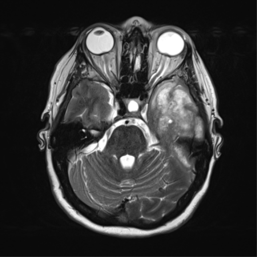 File:Cerebral metastasis mimicking glioblastoma (Radiopaedia 69155-78937 Axial T2 13).png