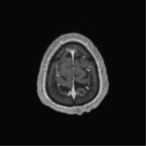 Cerebral metastasis to basal ganglia (Radiopaedia 81568-95413 Axial T1 C+ 69).png