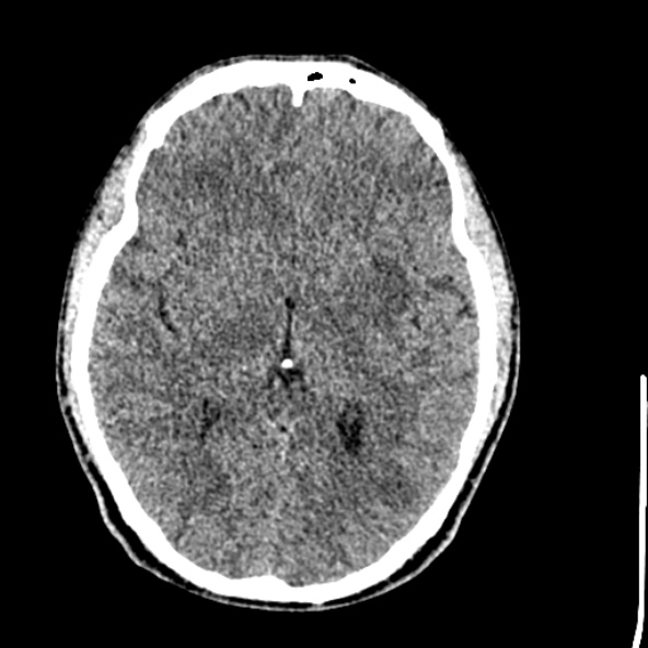 Cerebral toxoplasmosis (Radiopaedia 53993-60131 Axial non-contrast 40).jpg