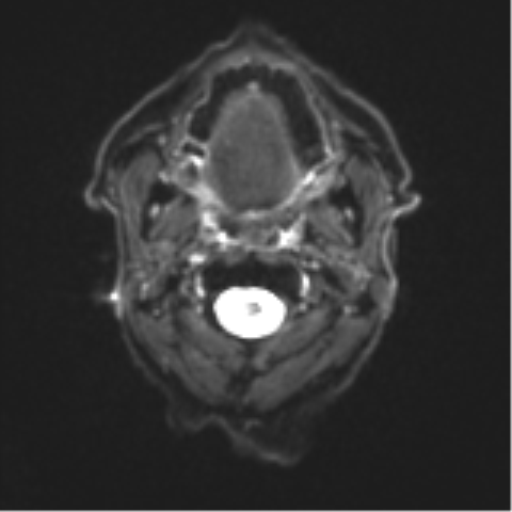 Cerebral toxoplasmosis (Radiopaedia 54575-60804 Axial DWI 1).png