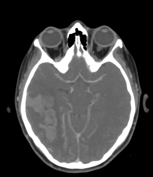 Cerebral venous hemorrhagic infarction (Radiopaedia 38461-40550 Axial MIP VENOGRAM 22).png