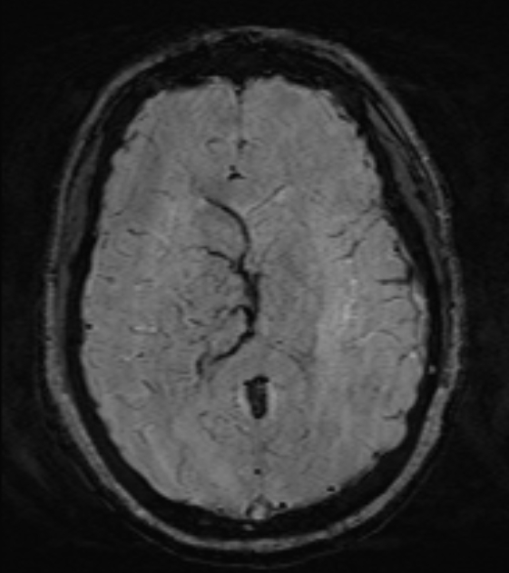 Cerebral venous infarct (Radiopaedia 53627-59685 Axial SWI 31).jpg