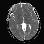 File:Cerebral venous infarction - hemorrhagic (Radiopaedia 81625-95505 Axial ADC 11).jpg