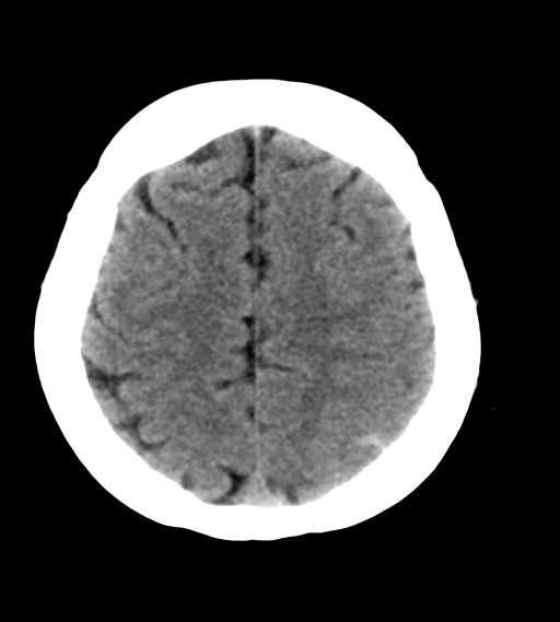 File:Cerebral venous infarction due to transverse sinus thrombosis (Radiopaedia 34688-36116 Axial non-contrast 22).png