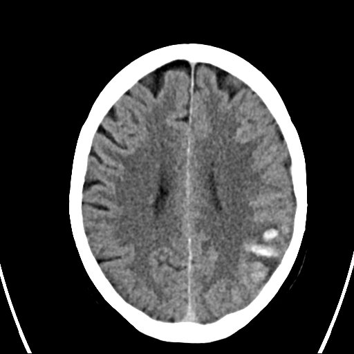 File:Cerebral venous infarction with hemorrhage (Radiopaedia 65343-74381 Axial non-contrast 17).jpg