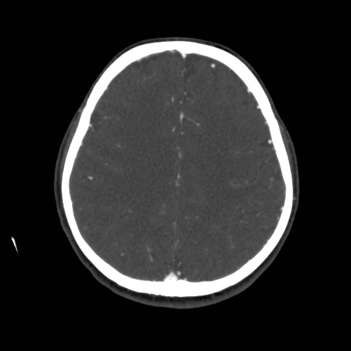 Cerebral venous sinus thrombosis (Radiopaedia 40619-43227 A 159).jpg