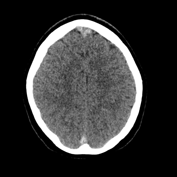 Cerebral venous sinus thrombosis (Radiopaedia 59224-66551 Axial non-contrast 33).jpg