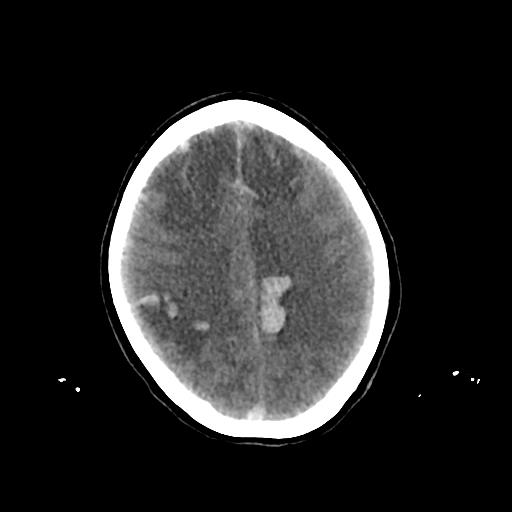 File:Cerebral venous throbmosis - hemorrhagic venous infarction (Radiopaedia 87318-103613 Axial non-contrast 120).jpg