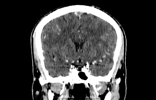 File:Cerebral venous thrombosis (CVT) (Radiopaedia 77524-89685 C 26).jpg