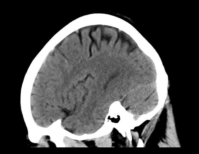 File:Cerebral venous thrombosis (Radiopaedia 38392-40467 C 9).png