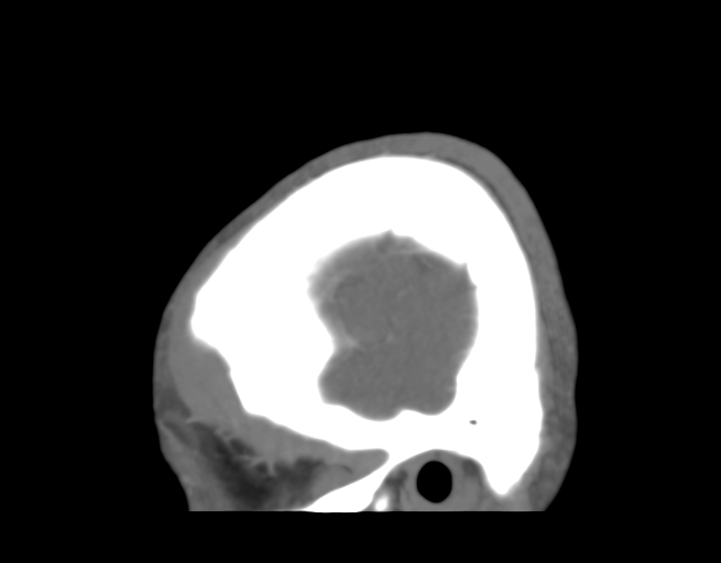 Cerebral venous thrombosis (Radiopaedia 38392-40467 D 5).png