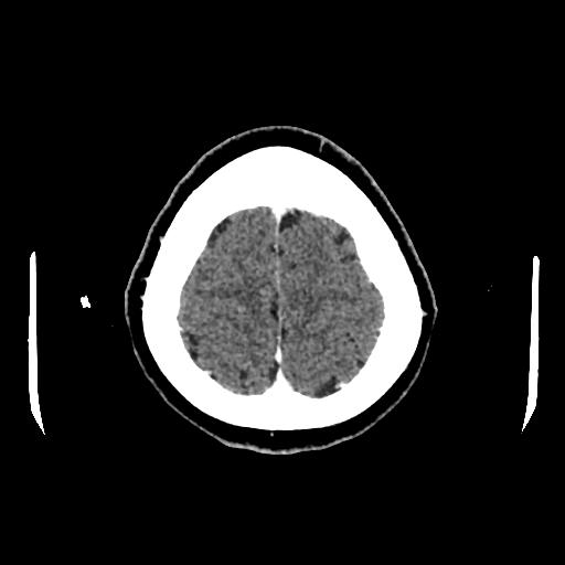 File:Cerebral venous thrombosis with venous hemorrhagic infarct (Radiopaedia 90354-107660 Axial with contrast 147).jpg