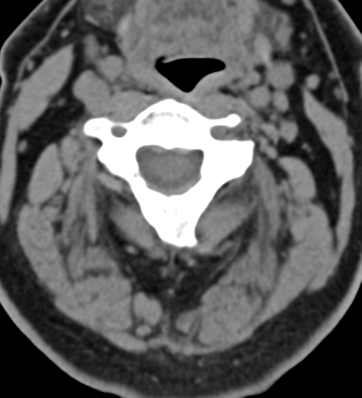 Cervical canal stenosis due to ossification of the posterior longitudinal ligament (Radiopaedia 47260-51823 Axial non-contrast 23).png