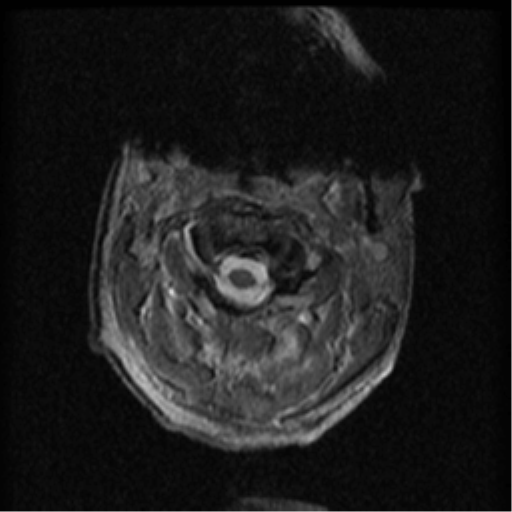 Cervical canal stenosis with cord compression (Radiopaedia 34114-35374 Axial Gradient Echo 86).png