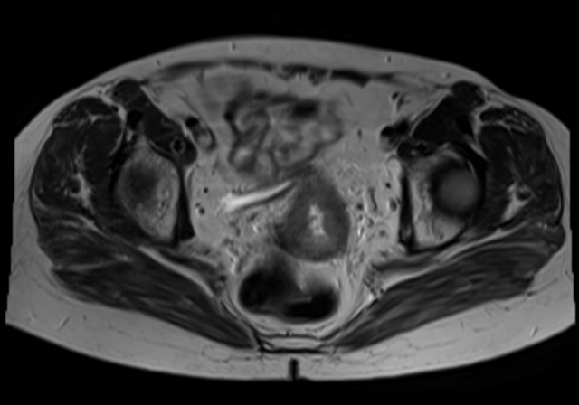 File:Cervical carcinoma (Radiopaedia 88312-104943 Sagittal T1 13).jpg