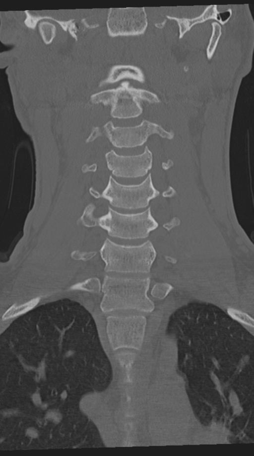 Cervical intercalary bone (Radiopaedia 35211-36748 Coronal bone window 34).png