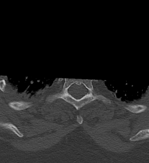 Cervical spine ACDF loosening (Radiopaedia 48998-54070 Axial bone window 63).png