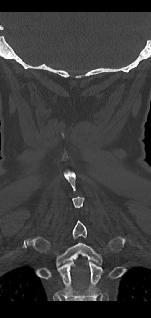 Cervical spine fracture - chalk stick (Radiopaedia 39116-41323 Coronal bone window 42).png
