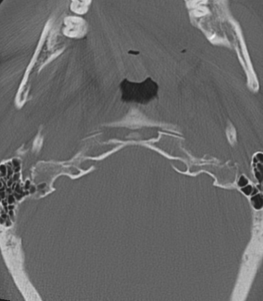 Cervical spine fractures with vertebral artery dissection (Radiopaedia 53296-59268 Axial bone window 8).png