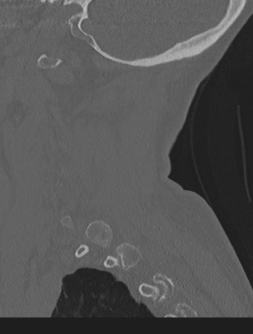 Cervical spondylolysis (Radiopaedia 49616-54811 Sagittal bone window 57).png