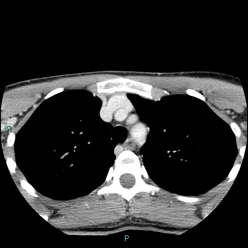 File:Cervical thymic cyst (Radiopaedia 88632-105335 C 4).jpg