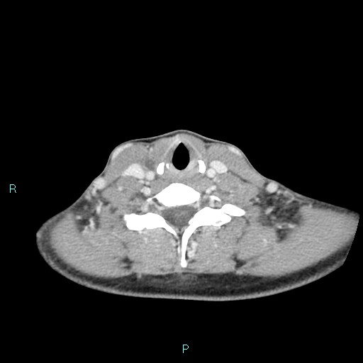 Cervical thymic cyst (Radiopaedia 88632-105335 C 45).jpg