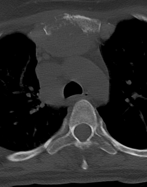 Cervical tuberculous spondylitis (Radiopaedia 39149-41365 Axial bone window 62).png
