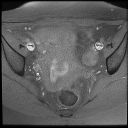 File:Cesarean scar ectopic pregnancy (Radiopaedia 77286-89362 Axial T1 fat sat 13).jpg