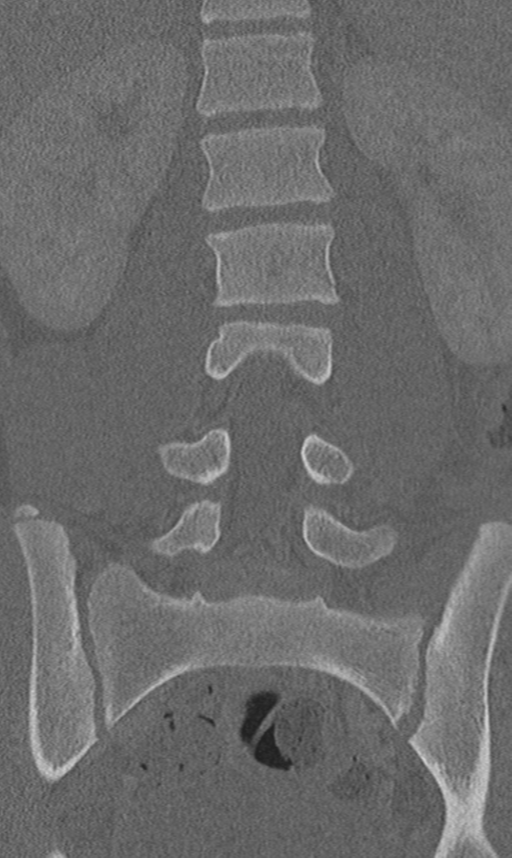 Chance fracture (Radiopaedia 40360-42912 Coronal bone window 34).png