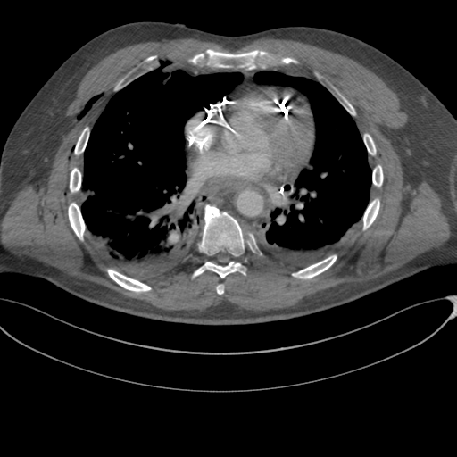File:Chest multitrauma - aortic injury (Radiopaedia 34708-36147 A 173).png