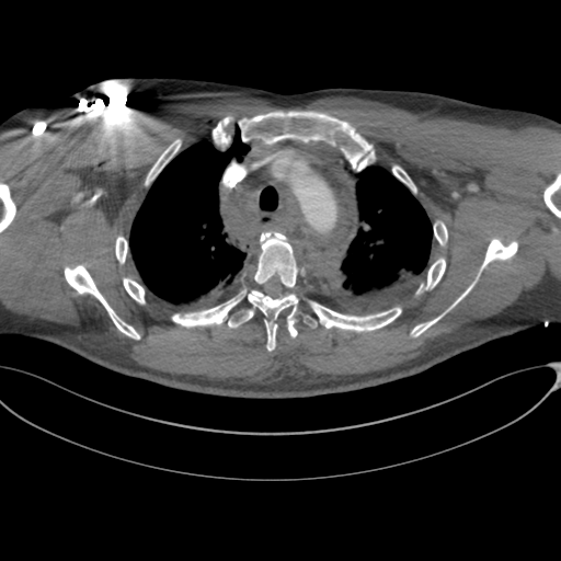 Chest multitrauma - aortic injury (Radiopaedia 34708-36147 A 75).png
