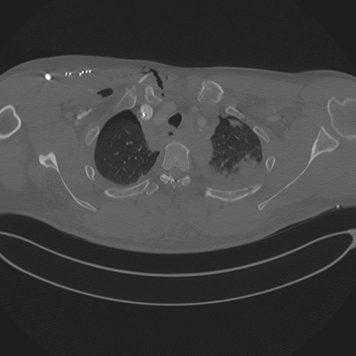 Chest multitrauma - aortic injury (Radiopaedia 34708-36147 Axial bone window 55).png