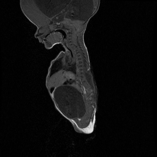 File:Chiari II malformation with spinal meningomyelocele (Radiopaedia 23550-23652 Sagittal T1 5).jpg