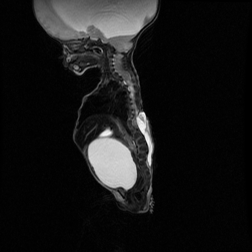 File:Chiari II malformation with spinal meningomyelocele (Radiopaedia 23550-23652 Sagittal T2 7).jpg