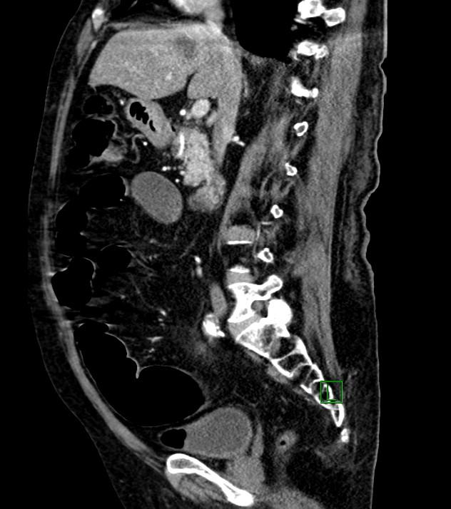 Cholangiocarcinoma with cerebral metastases (Radiopaedia 83519-98629 F 70).jpg