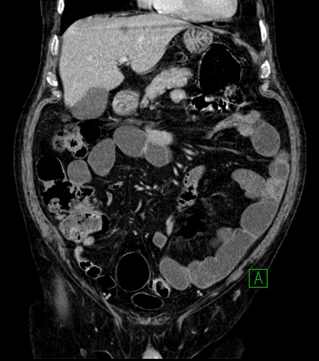 Cholangiocarcinoma with cerebral metastases (Radiopaedia 83519-98629 G 28).jpg