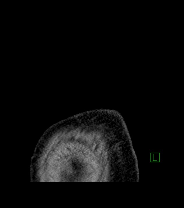 Cholangiocarcinoma with cerebral metastases (Radiopaedia 83519-98629 Sagittal C+ delayed 1).jpg