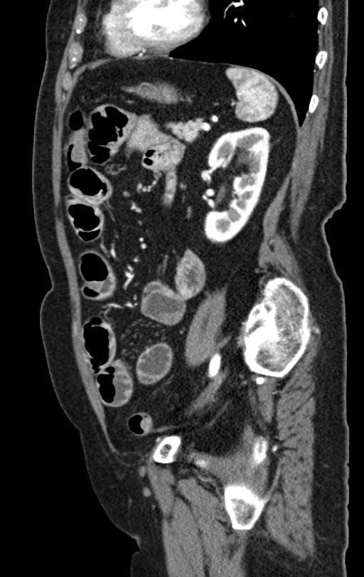 Cholecystoduodenal fistula due to calculous cholecystitis with gallstone migration (Radiopaedia 86875-103077 C 20).jpg