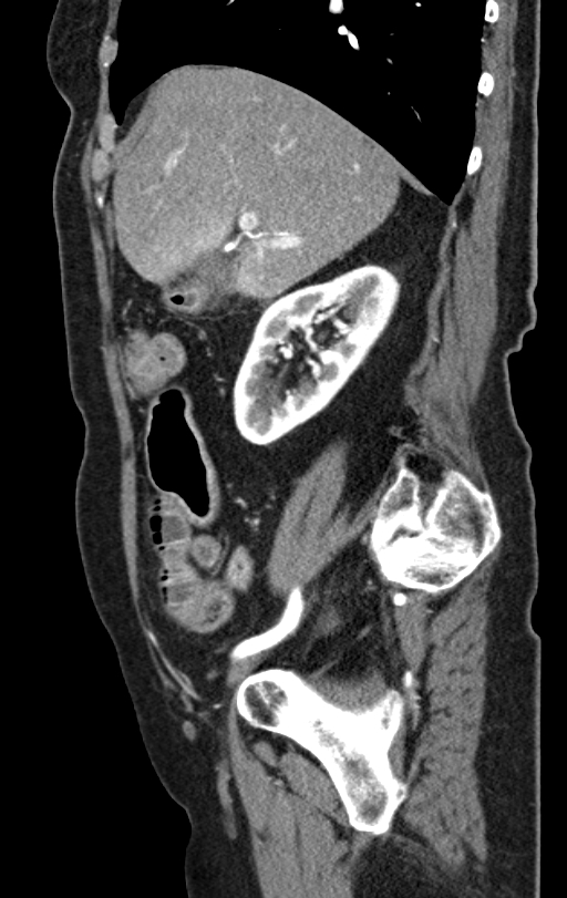 Cholecystoduodenal fistula due to calculous cholecystitis with gallstone migration (Radiopaedia 86875-103077 C 43).jpg