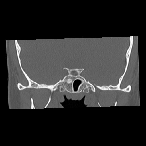 Cholesteatoma (Radiopaedia 84960-100474 Coronal bone window 11).jpg