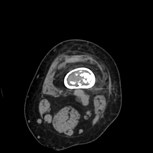 File:Chondrosarcoma - femur (Radiopaedia 64187-72954 Axial non-contrast 21).jpg