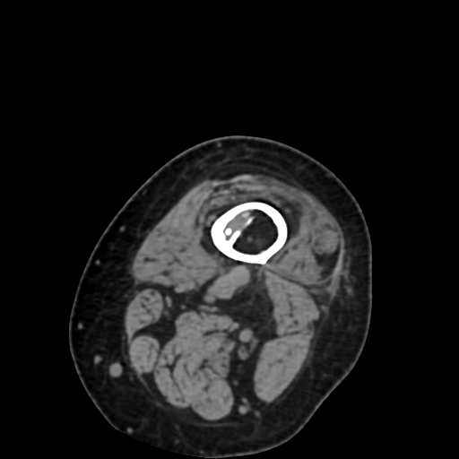 Chondrosarcoma - femur (Radiopaedia 64187-72954 Axial non-contrast 7).jpg
